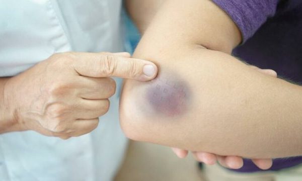 Nuk e keni ditur deri më tani por ja pse ndodh mavijosja në trupin tuaj! Kur duhet të shqetësoheni!