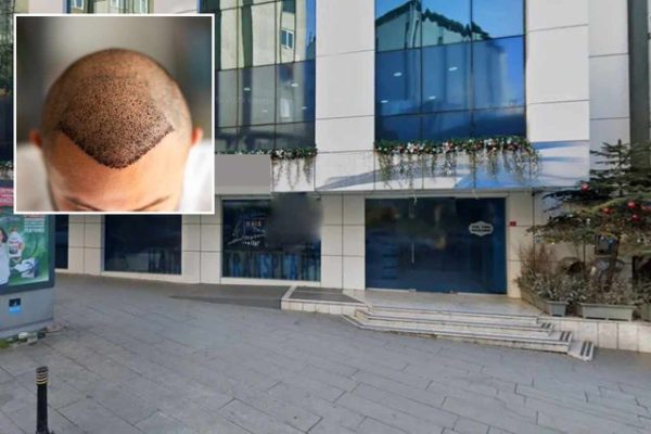 E rëndë/ Humb jetën 38-vjeçari pas mbjelljes së flokëve në një klinikë (Detajet e renda)